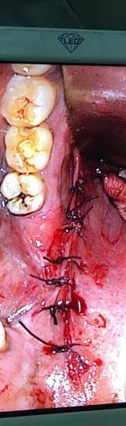 Photos of Minimal Access ENT Surgery Minimal access ENT surgery